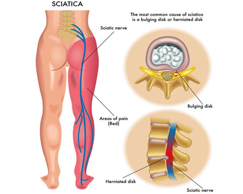 Sleeping with Sciatica, Spinal Stenosis and Herniated Discs - Contour Living