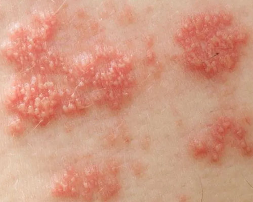 Post Herpes Zoster Pain Treatment