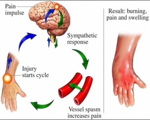 Complex Regional Pain Syndrome Treatment