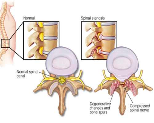Back pain treatment for lumbar spinal stenosis